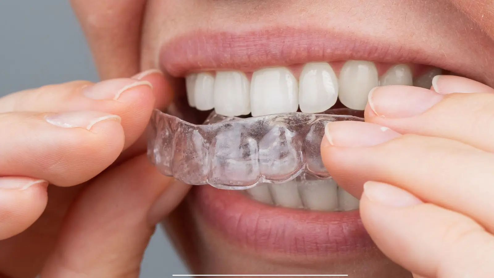 Allineatori trasparenti per la chiusura di un diastema