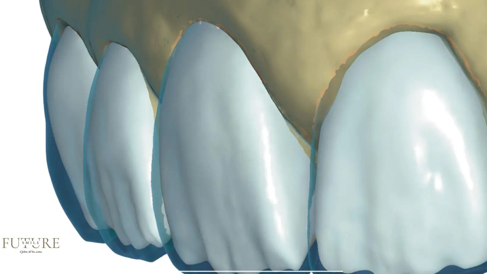 Simulazione digitale del risultato Future Smile